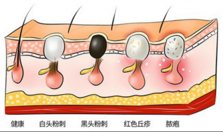 讓黑頭乖乖跑出來，黑頭儀有用嗎？