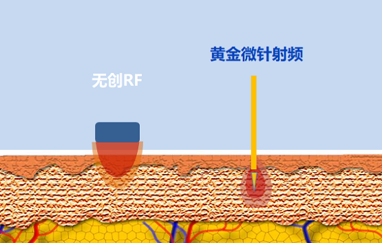 抗衰選熱瑪吉還是黃金微針？看老司機(jī)全面解讀！