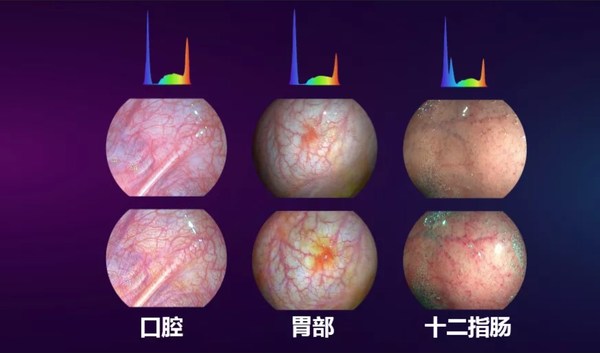 光隨影動 開立醫(yī)療國產(chǎn)內(nèi)鏡功能領跑智能新方向