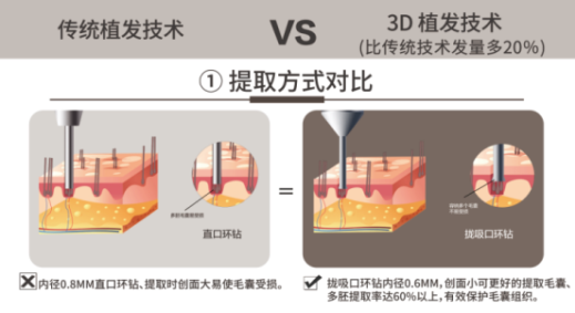 溫州新生植發(fā)：3D植發(fā)技術(shù)享譽(yù)國(guó)際，受毛發(fā)領(lǐng)域?qū)＜屹澷p