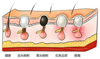 HomeFacialPro乳糖酸去黑頭鼻貼膜全新上市 抑制頑固黑頭反復(fù)上演